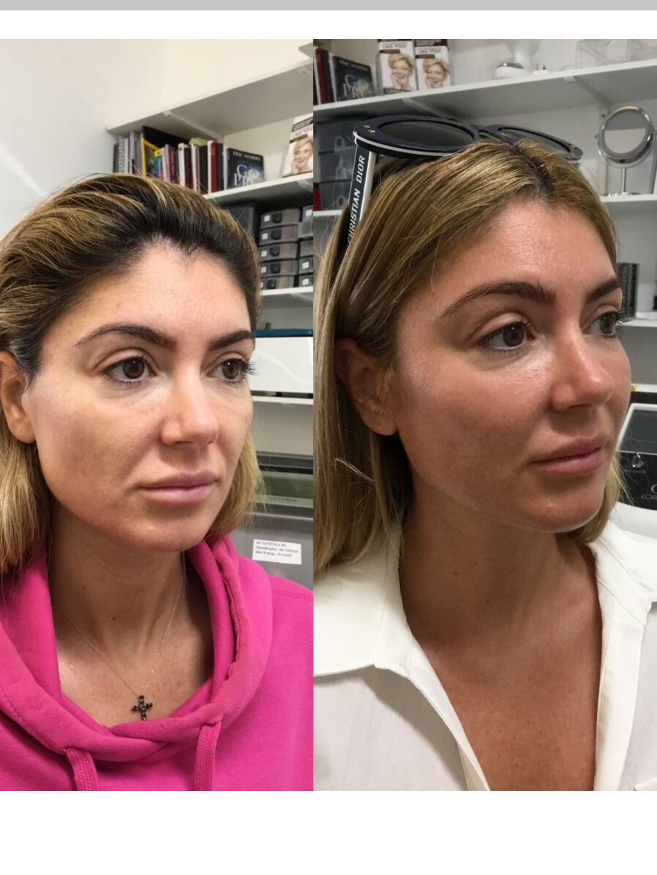 non surgical facelift done at our london clinic before and aftrer for lady over 40