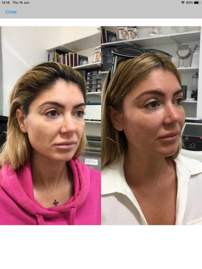 Cheek filler on over 40s before and after in London