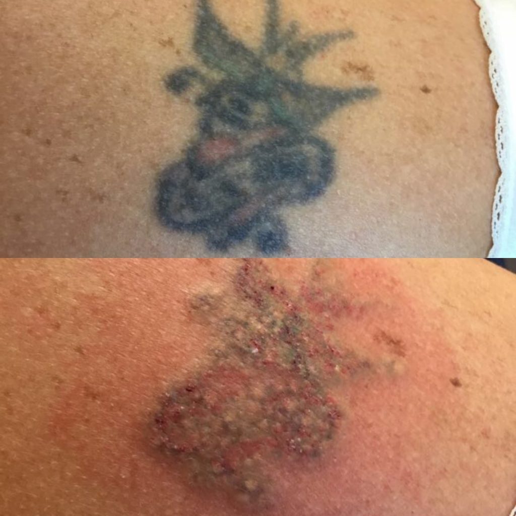 Laser tattoo removal  before and after in London