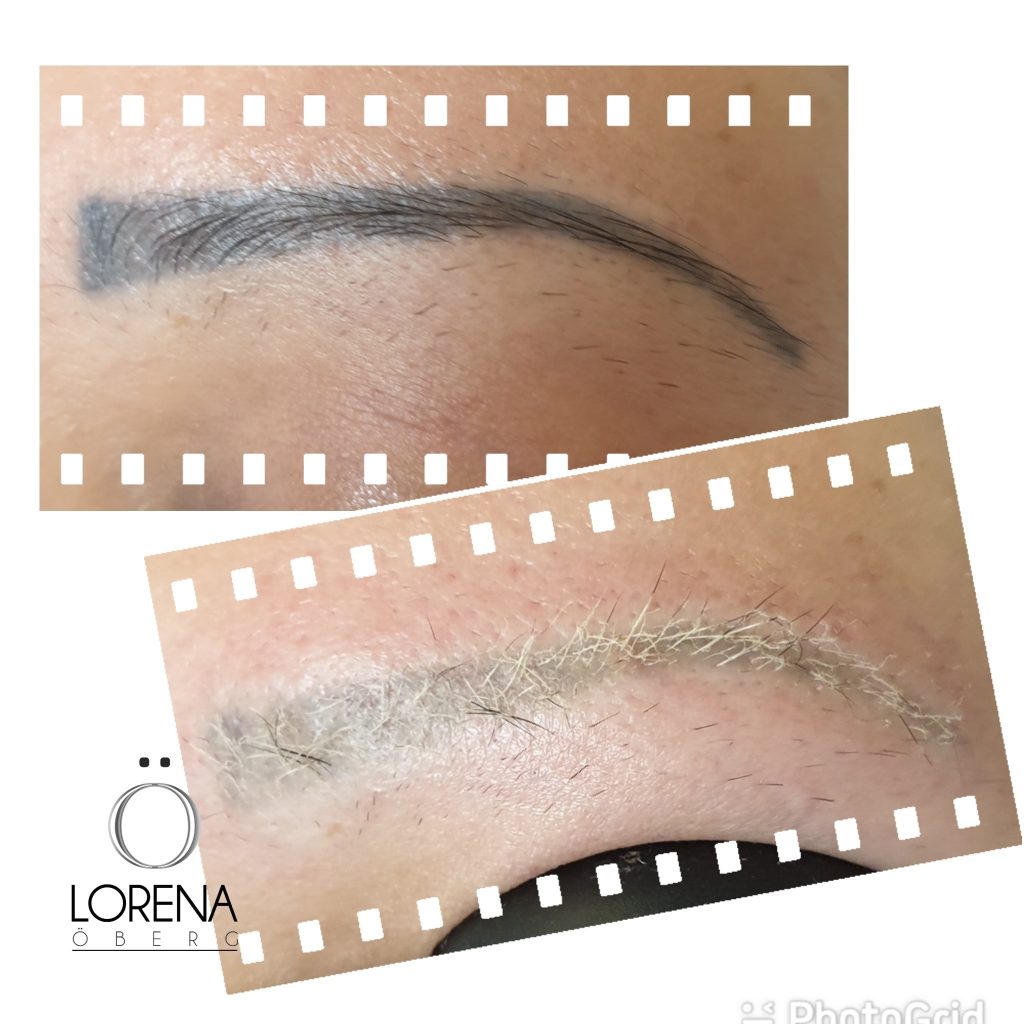 Laser permanent makeup removal of old brow in London