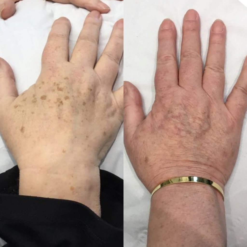 sun spot laser removal from hands before and after in London