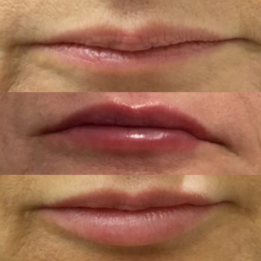 Natural lip fillers before after for over 40s and 50s