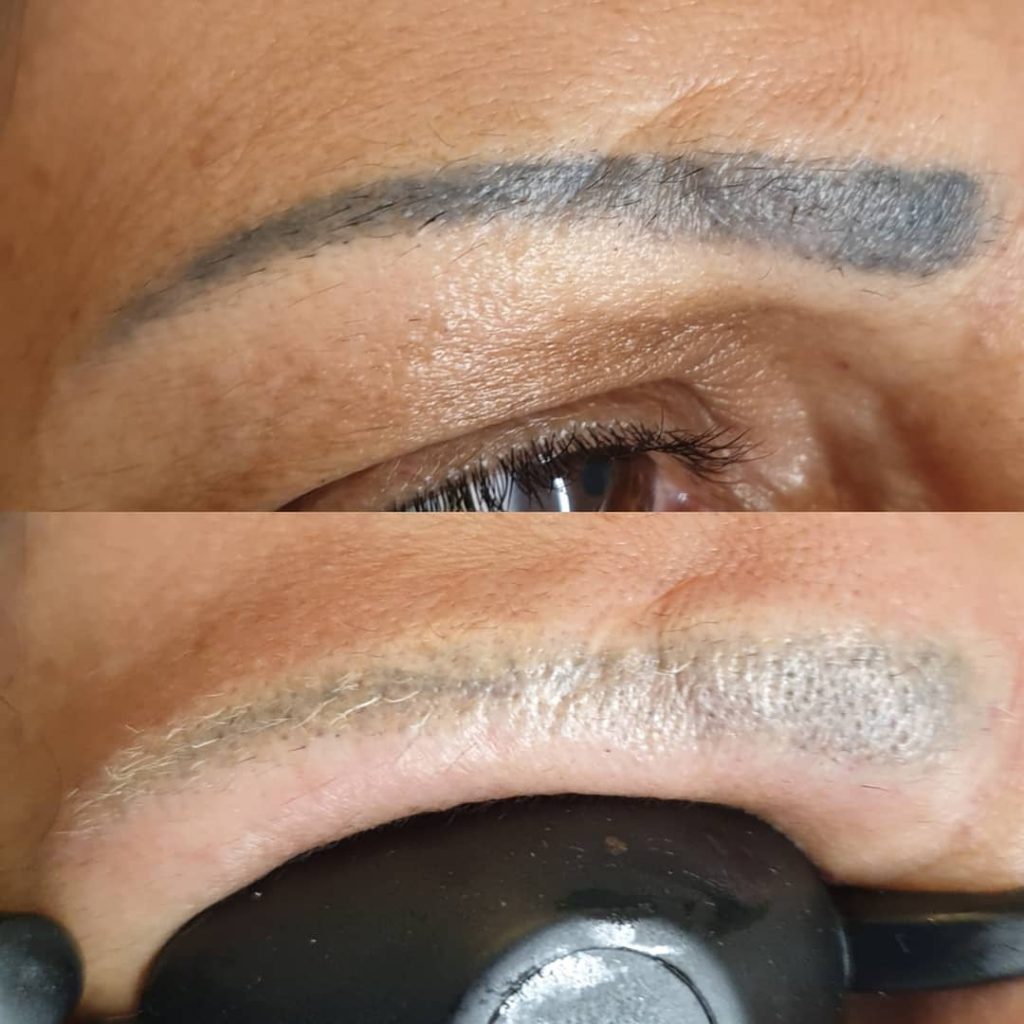 permanent makeup removal on dark Asian and African skin in London