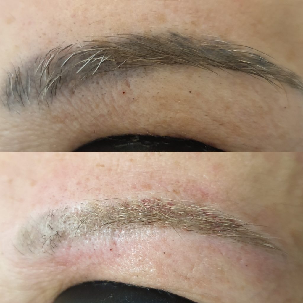 permanent makeup removal of old migrated brow in London