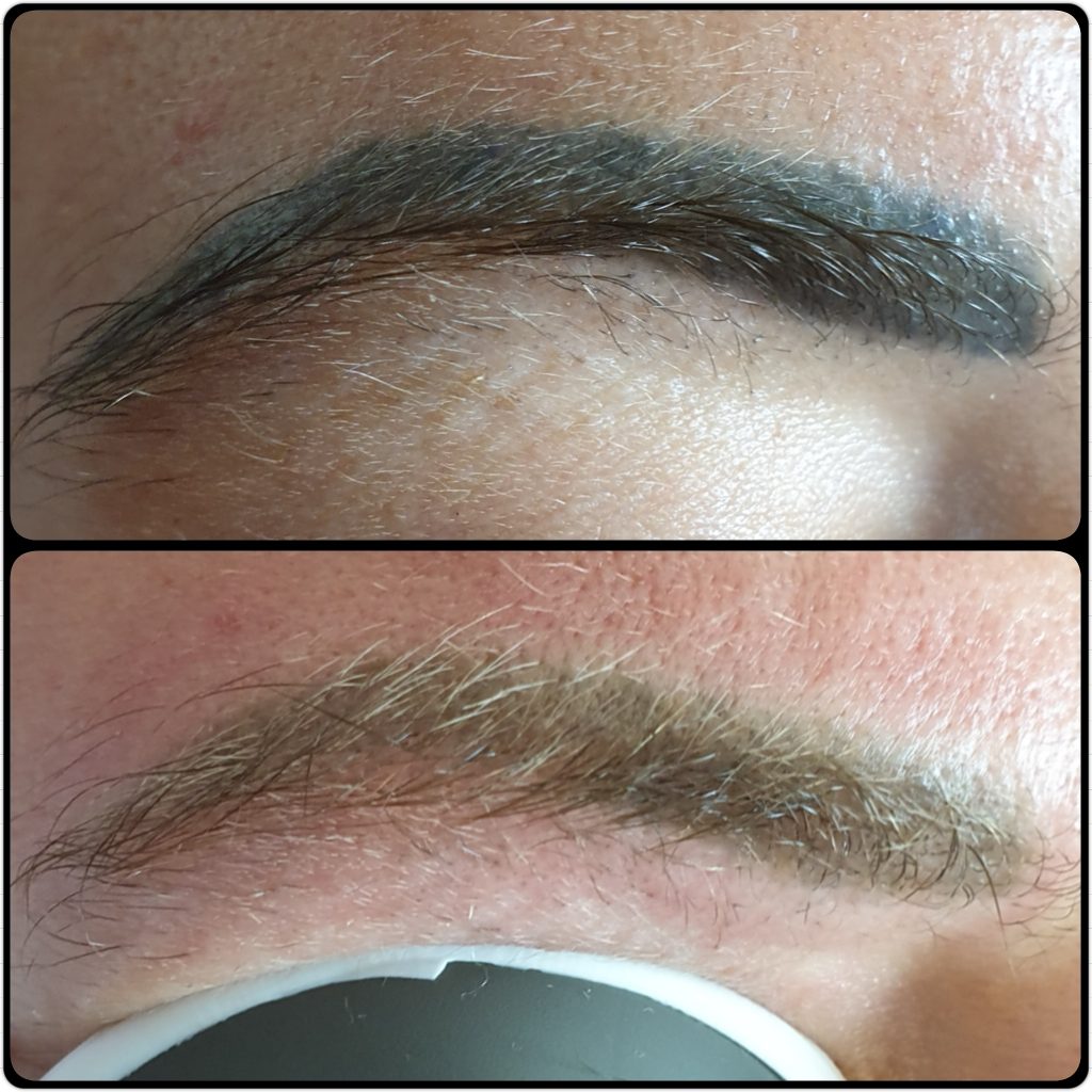 Permanent makeup removal of old black brows in London