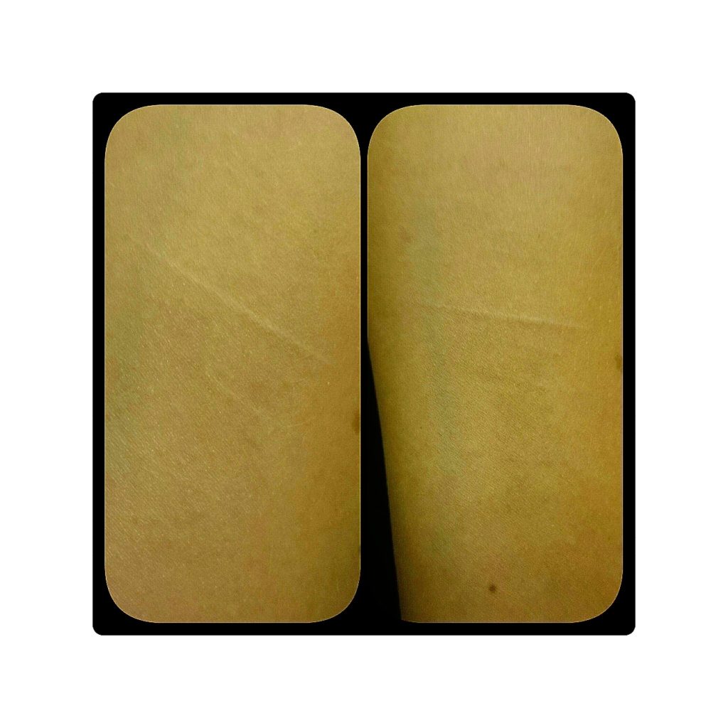 self harm removal treatment on dark Asian African skin in London Before and after