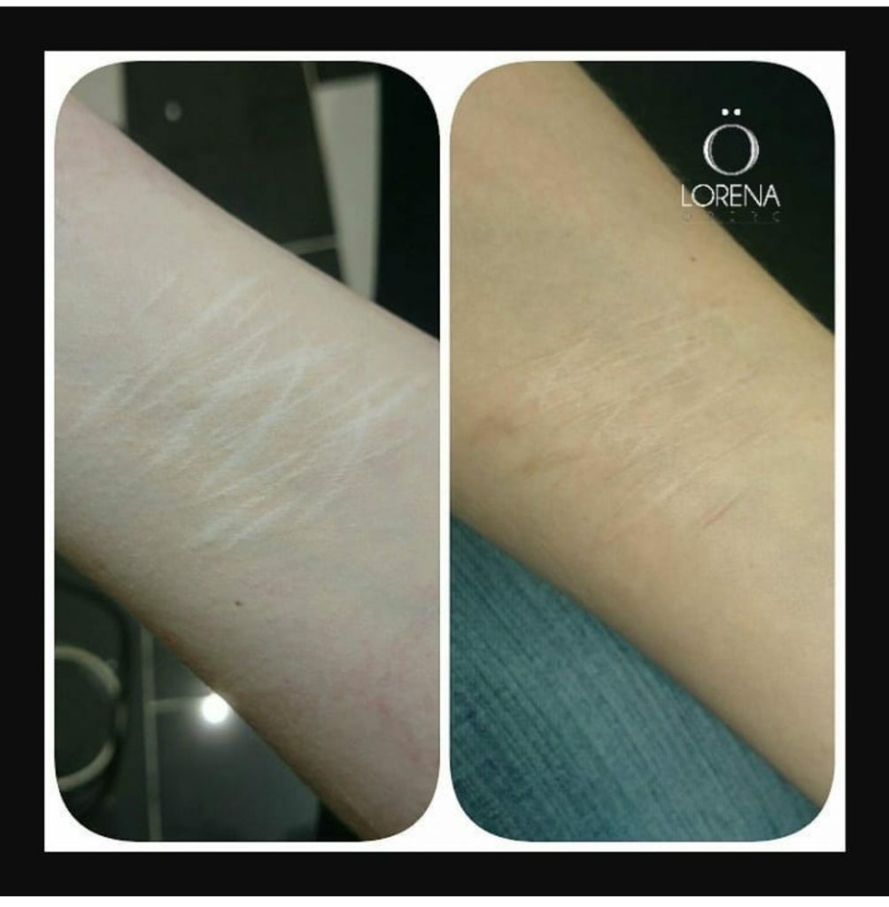 Self harm removal treatmet in London before and after