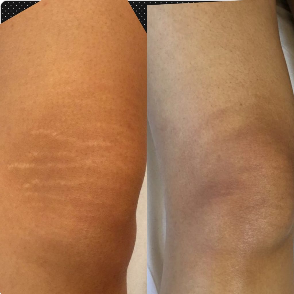stretch marks removal treatment knees dark skin