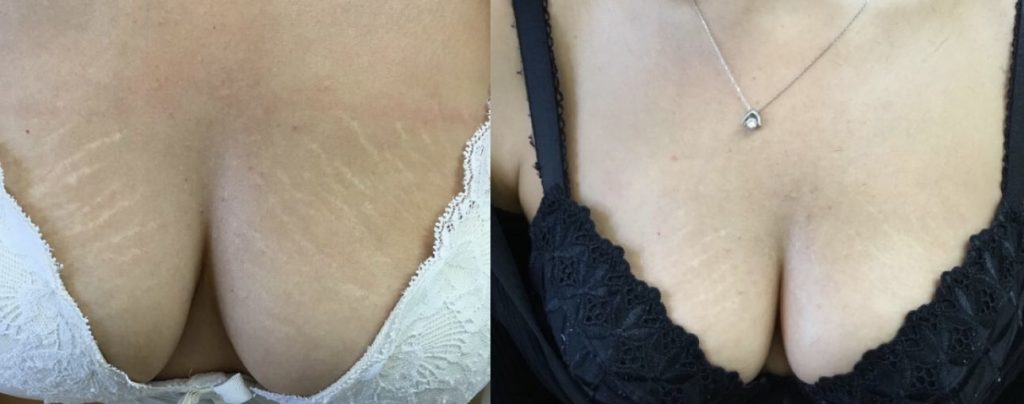 DermaEraze Stretch marks removal treatment on the breast before and after London