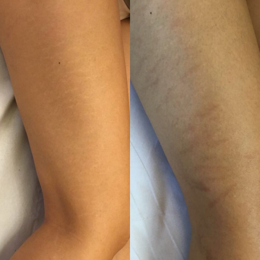 DermaEraze stretch marks removal treatment on legs on Asian , Indian skin before and after.  London