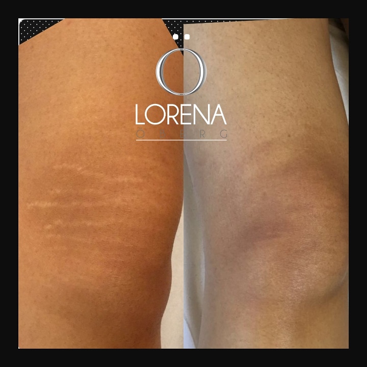 DermaEraze stretch marks removal treatment on knees on Asian , Indian skin before and after.  London