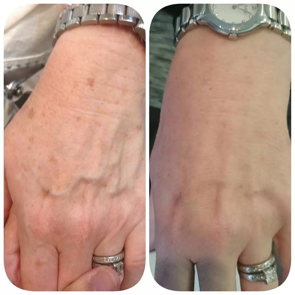 Liver spots on hands before and afters, sun spot removal in London
