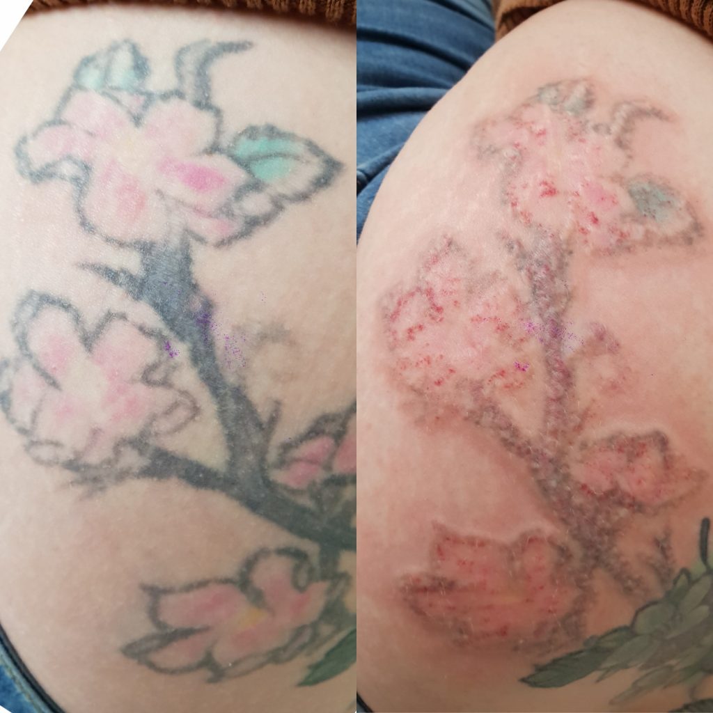 Laser tattoo removal before and after in London