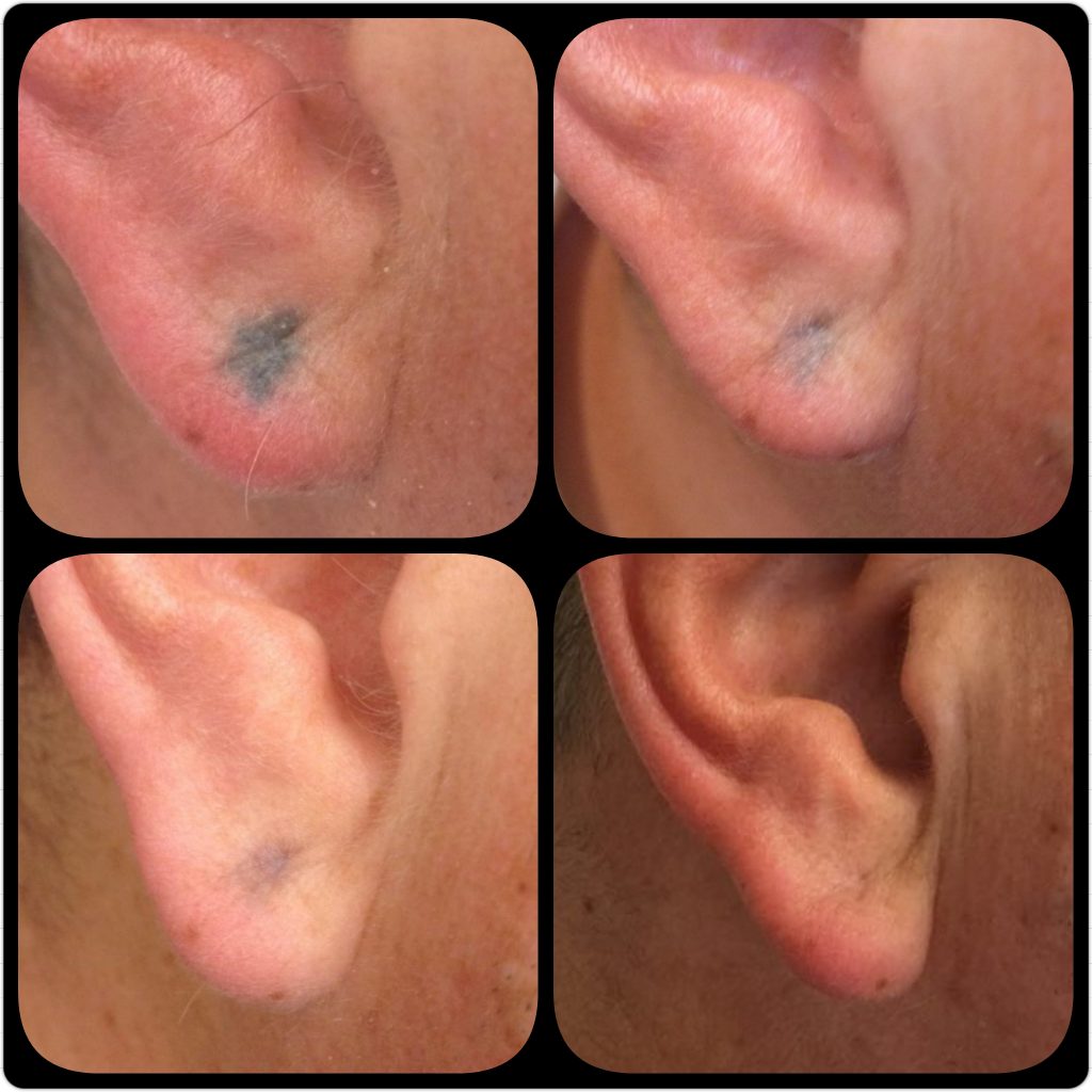 Laser tattoo removal on the ear before and after tattoo removal process in London