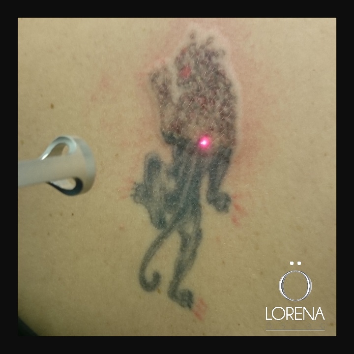 tattoo removal black before after