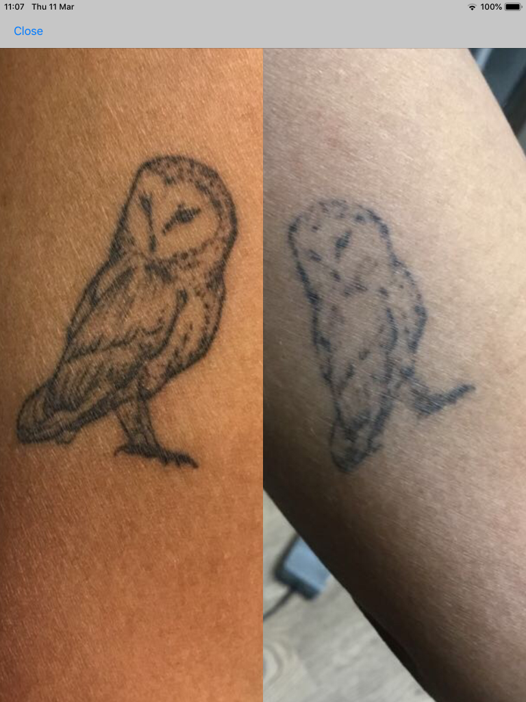 tattoo removal before and after.  
