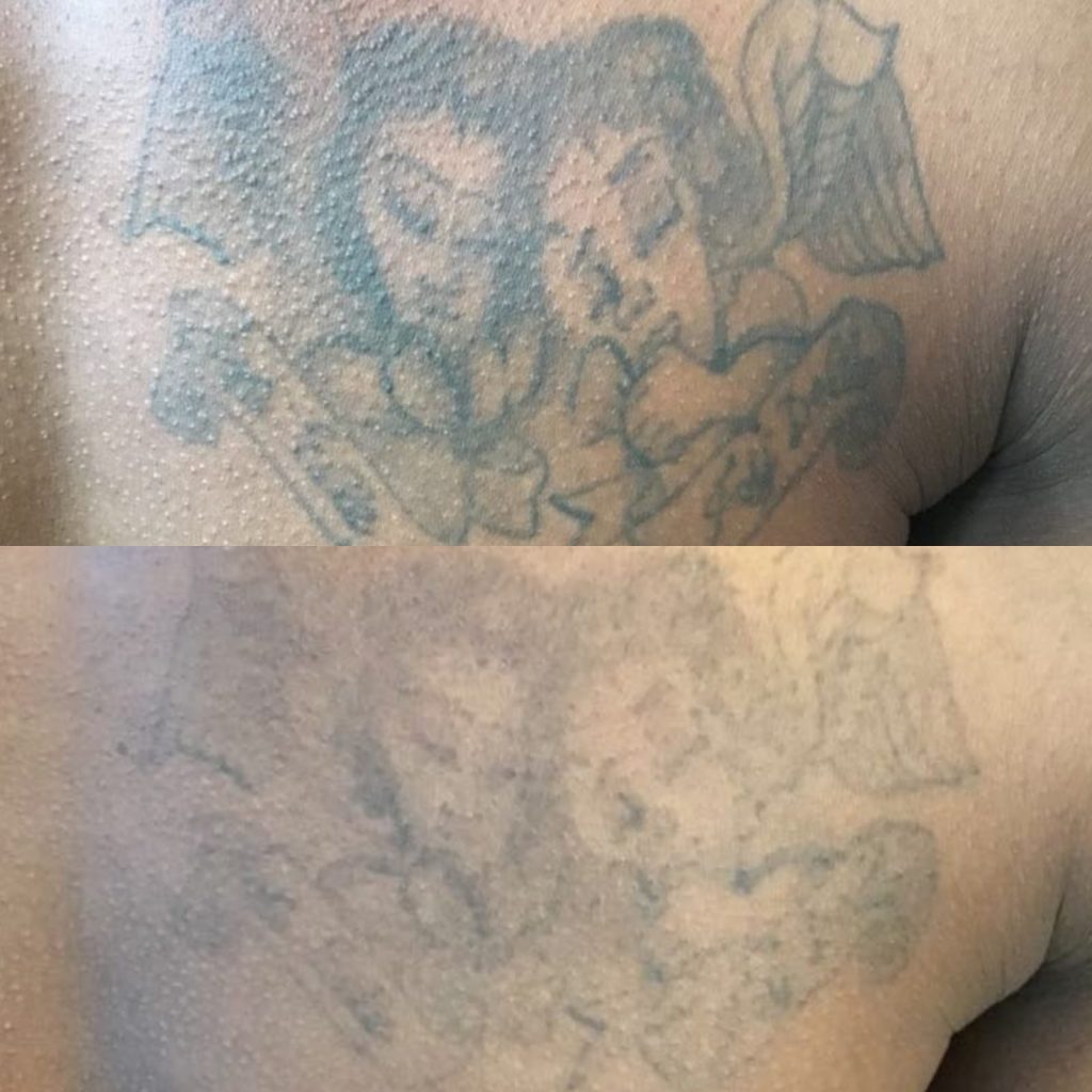 tattoo removal black skin before and after