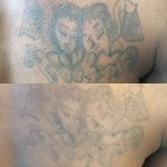 Laser tattoo removal before and after on black dark skin in London. Tattoo removal expert
