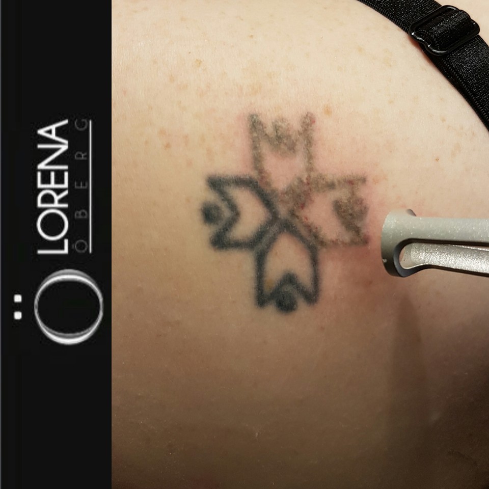 laser tattoo removal procedure in london 