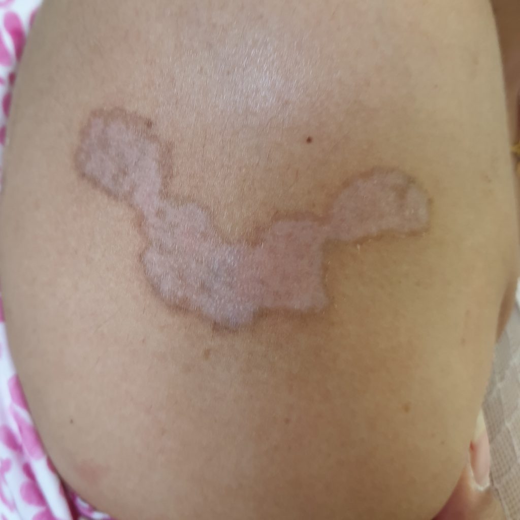 Tattoo removal scar