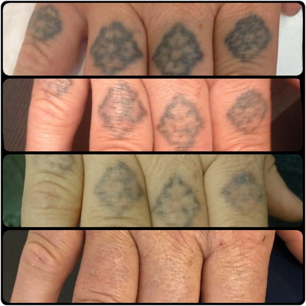 tattoo removal process before after