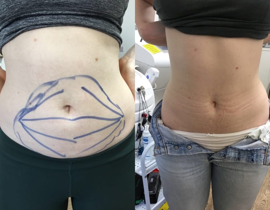 Aqualyx Fat Dissolving Injection on the stomach area before and after