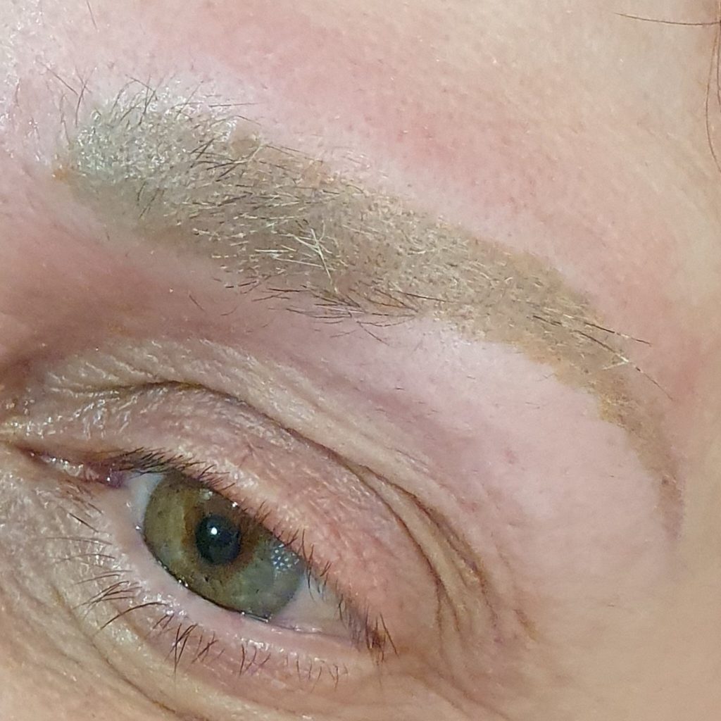 Microblading removal of yellow  pigment brow pigment with laser in London