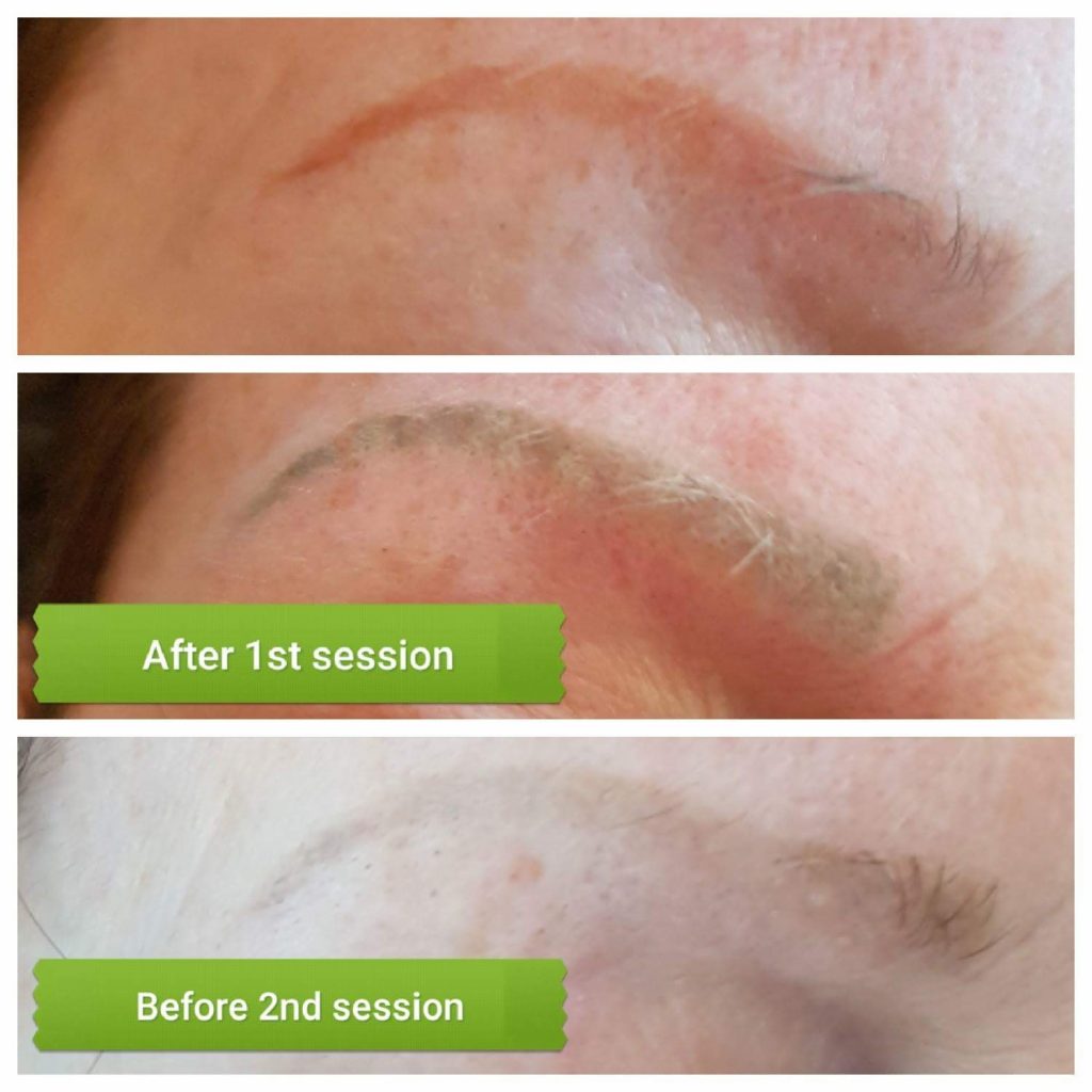 Titanium based brow removal before and after