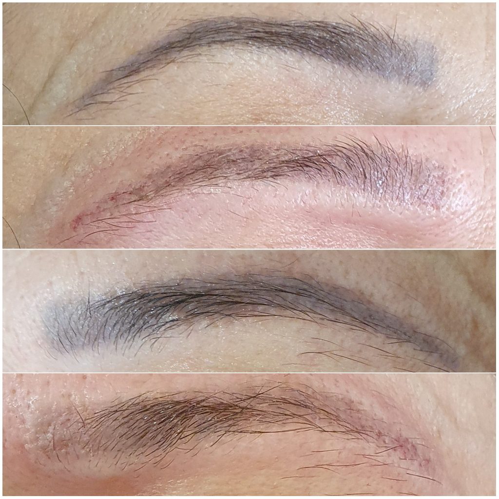 Microblading Removal with laser london