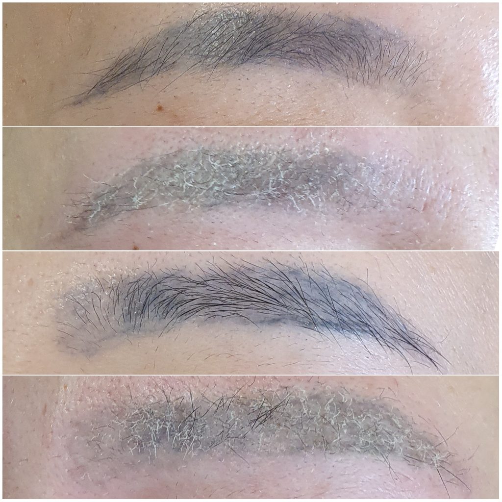 microblading removal laser white hair