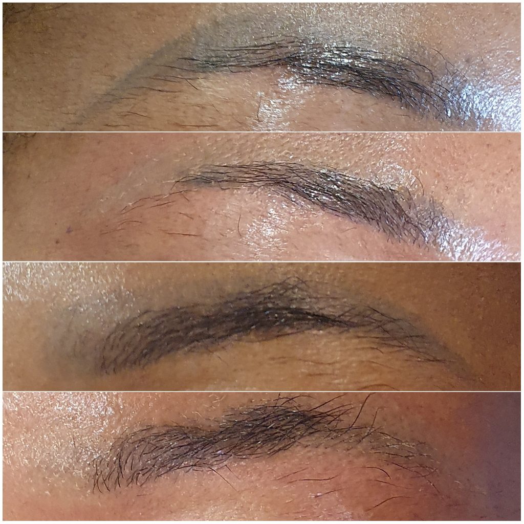 laser microblading removal on Asian skin 