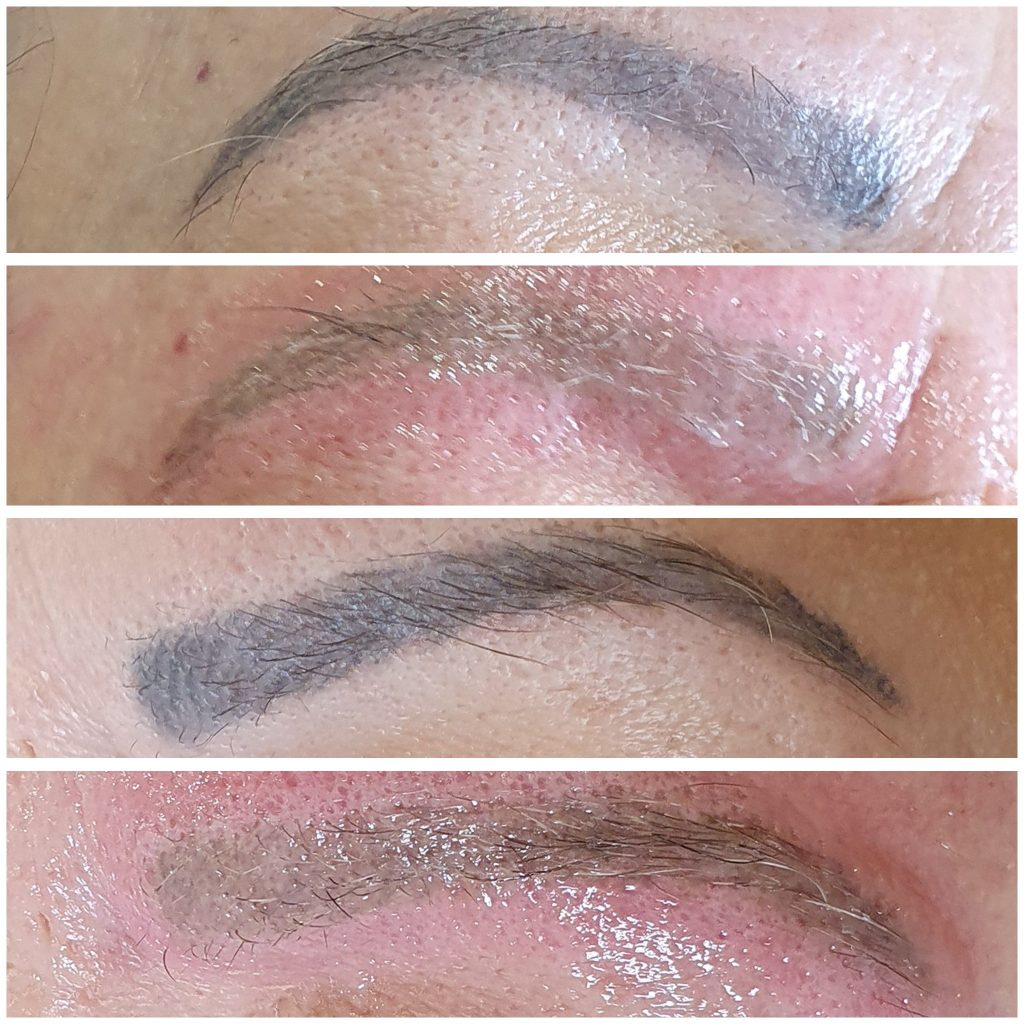 Permanent Makeup Removal in London
