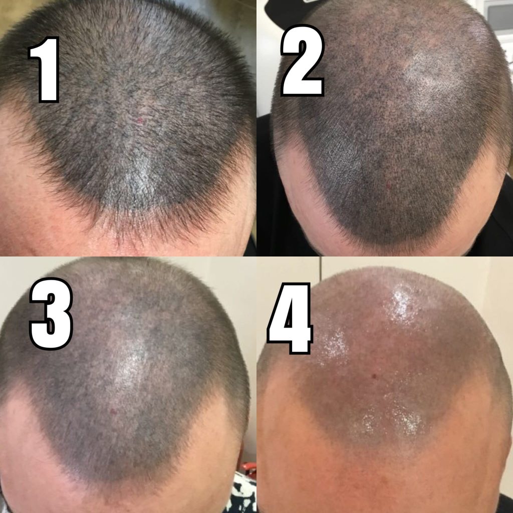 How to Fade Scalp Micropigmentation When It's Turned Out Too Dark  Before and after