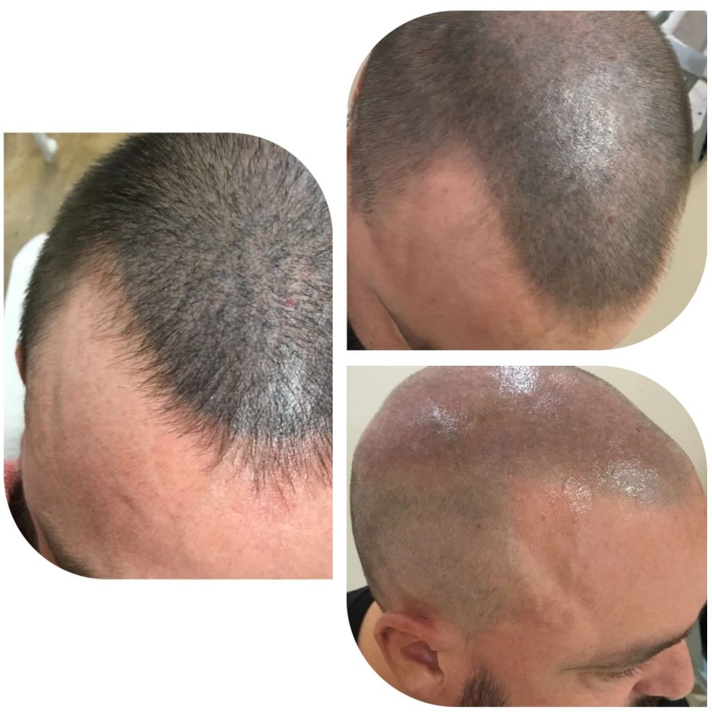 How to Fade Scalp Micropigmentation When It's Turned Out Too Dark  before and after
