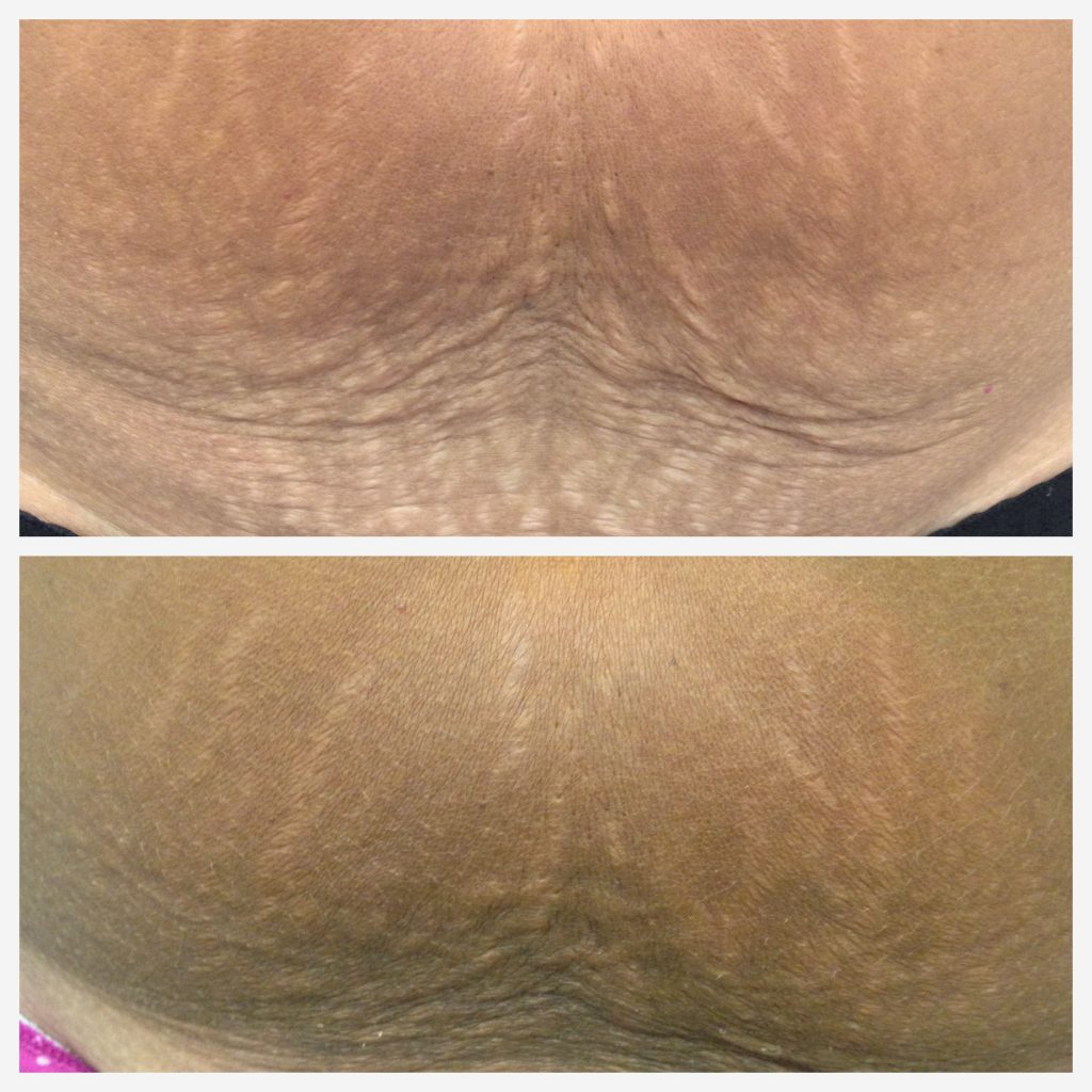 Stretch marks treatment in Hurghada, health tourism in Egypt.  