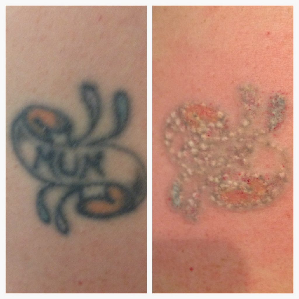 Laser tattoo removal before and after in Hurghada - إزالة الوشم بالليزر في الغردقة