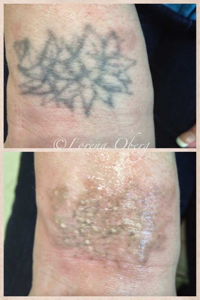Laser tattoo removal before and after in Hurghada - إزالة الوشم بالليزر في الغردقة