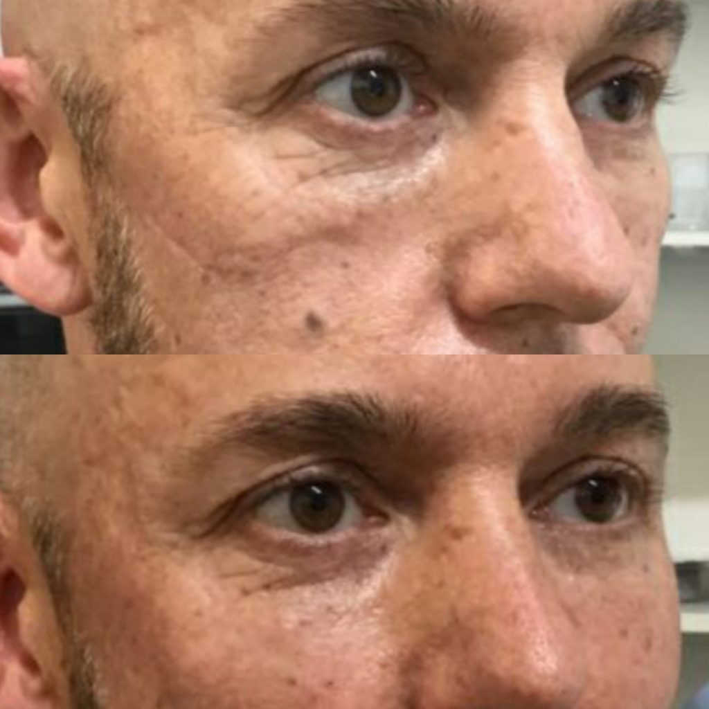 Male under-eye dermal filler treatment showing natural results in Hurghada نتائج فيلر الهالات السوداء للرجال في الغردقة
