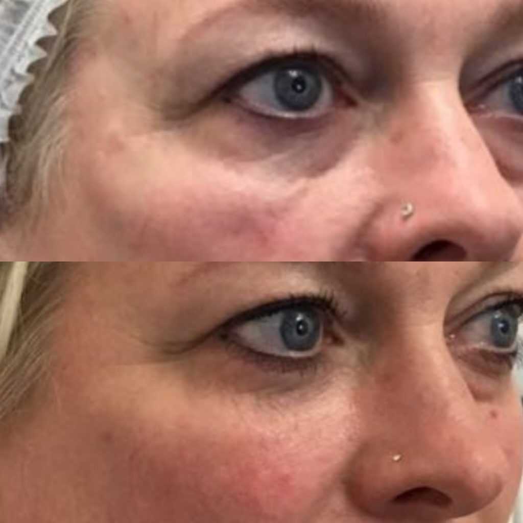 Before and after of woman receiving natural tear trough filler in Hurghada clinic   قبل وبعد فيلر تحت العين في الغردقة
