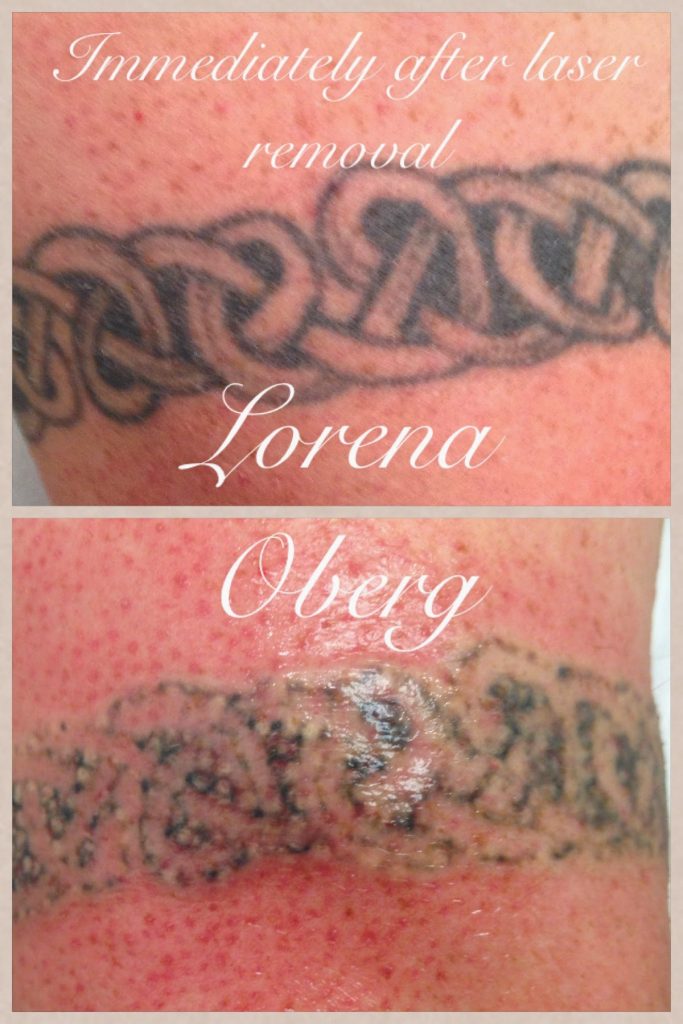 Laser tattoo removal before and after in Hurghada - إزالة الوشم بالليزر في الغردقة