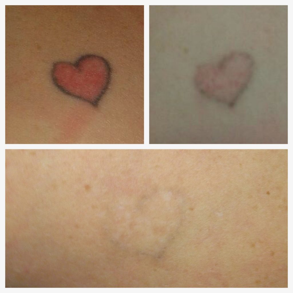 Laser tattoo removal before and after in Hurghada - إزالة الوشم بالليزر في الغردقة