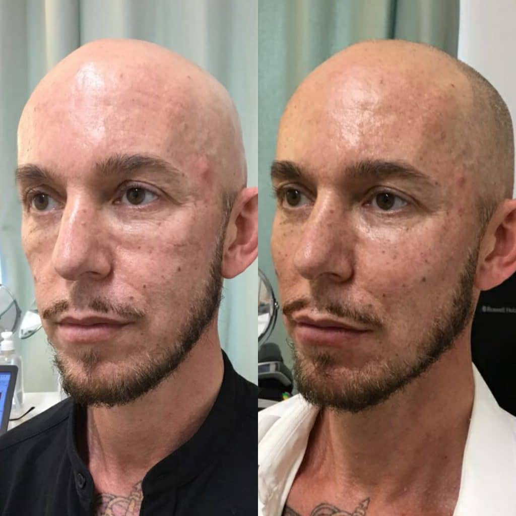 cheekbone fillers in Hurghada, high cheeks fillers حقن حشو عظام الخد في الغردقة، حقن حشو الخدين العاليين